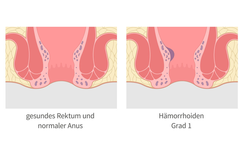 Schaubild mit links einem gesunden Rektum und rechts einem Rektum mit Hmorrhoiden
